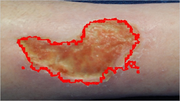 Wound boundary determination